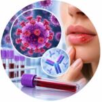 Herpes simplex virus 1 (HSV-1) - IgG