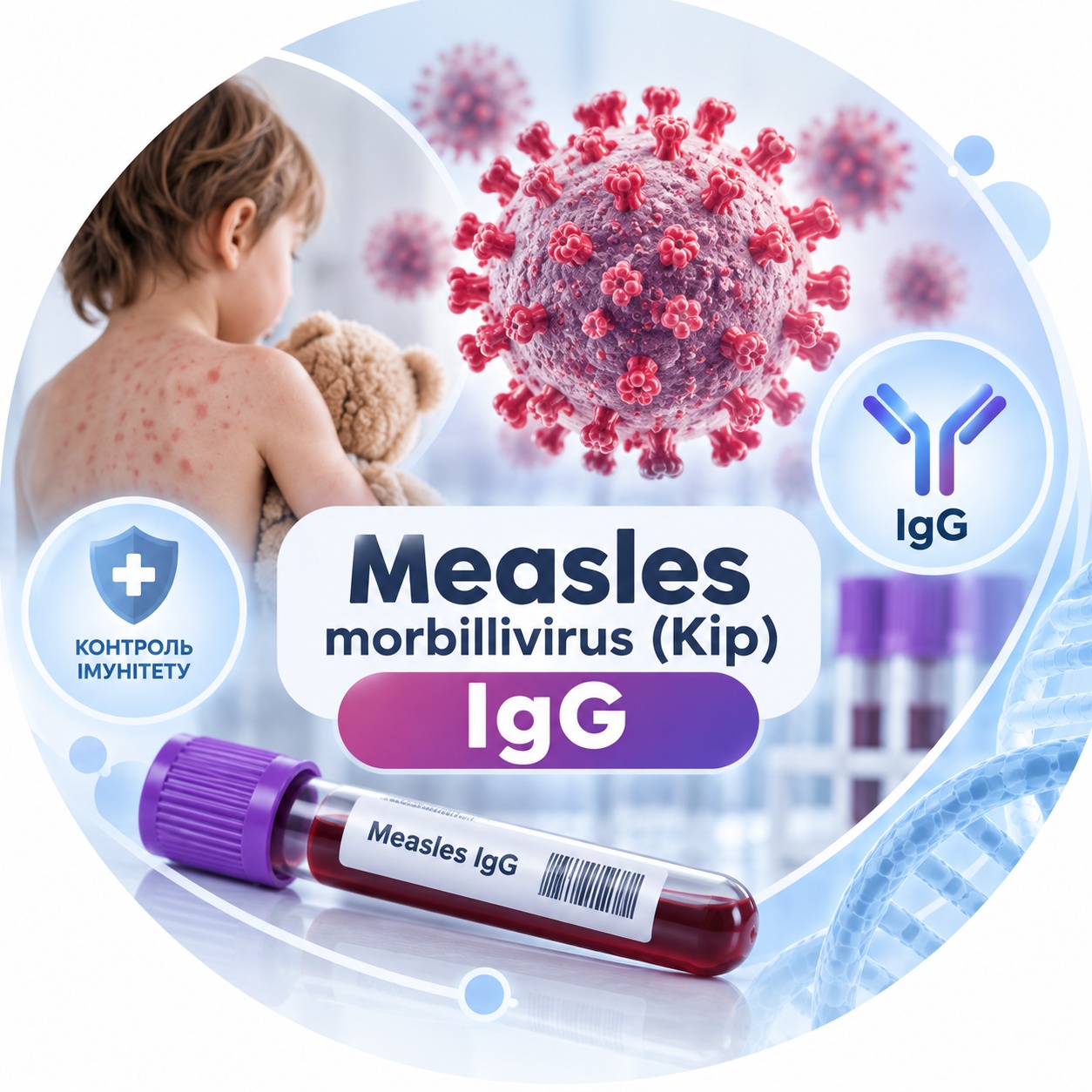 Measles morbillivirus (Кір) — антитіла IgG IgG to measles virus — serological test