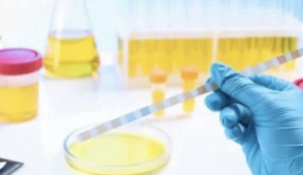 Complete urinalysis (CUR)