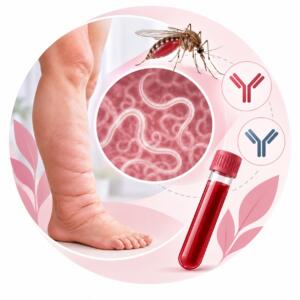 Filariasis IgA IgG – анализ на филяриоз