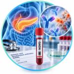 Blood test for antibodies to glutamic acid decarboxylase GADA — Medi Lab Plus