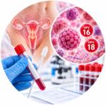 Analysis of HPV DNA types 16 and 18 by qualitative determination method