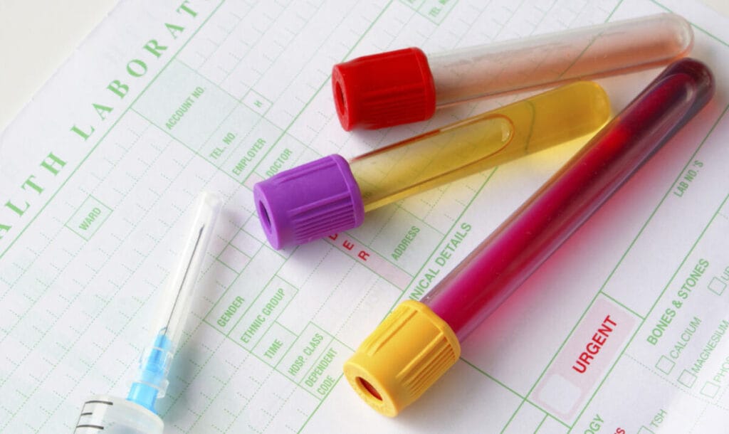 TORCH blood test in a pregnant woman