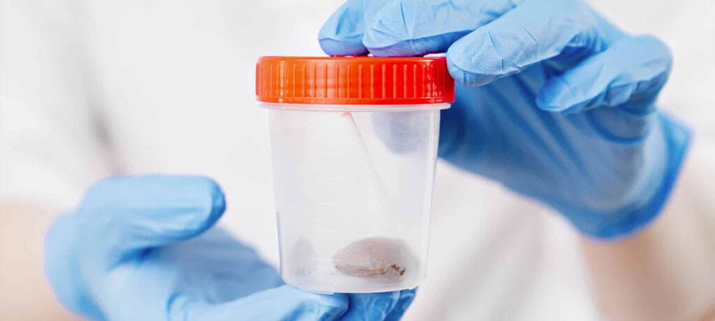 образец кала в лабораторном контейнере