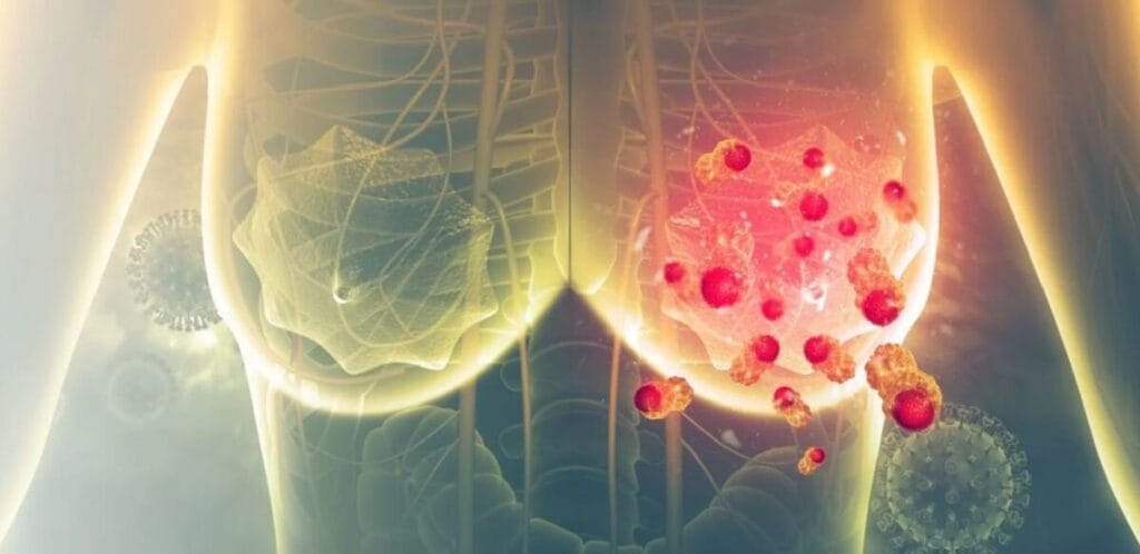 врач держит результаты анализа на онкомаркеры груди