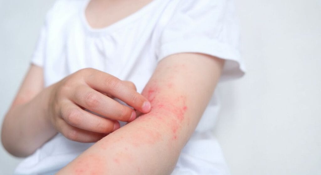 A young child is being tested for allergies