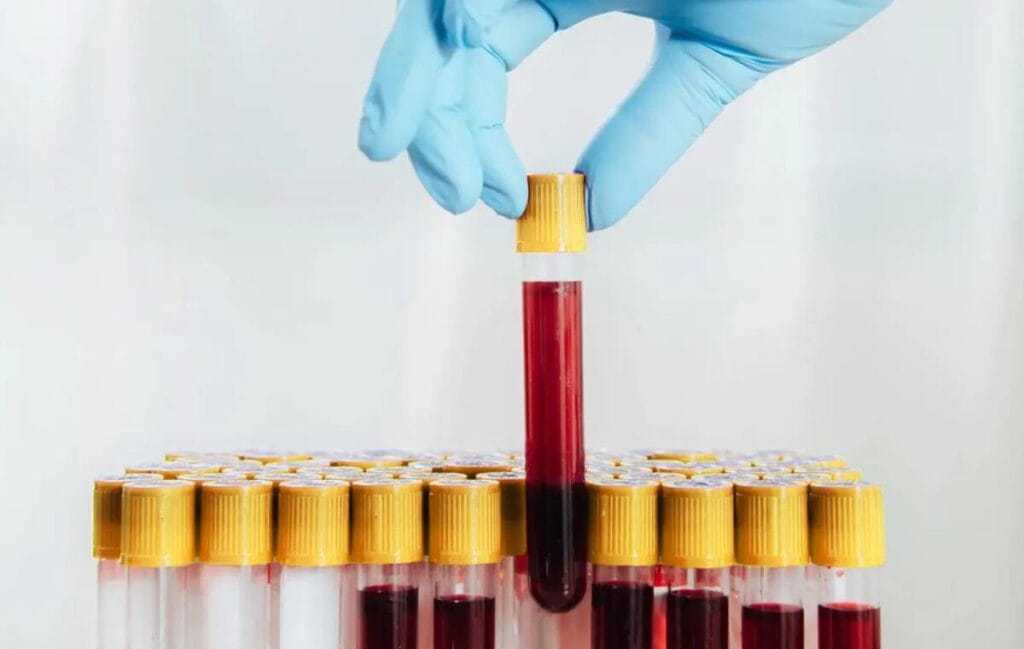 Blood test for lung cancer tumor markers