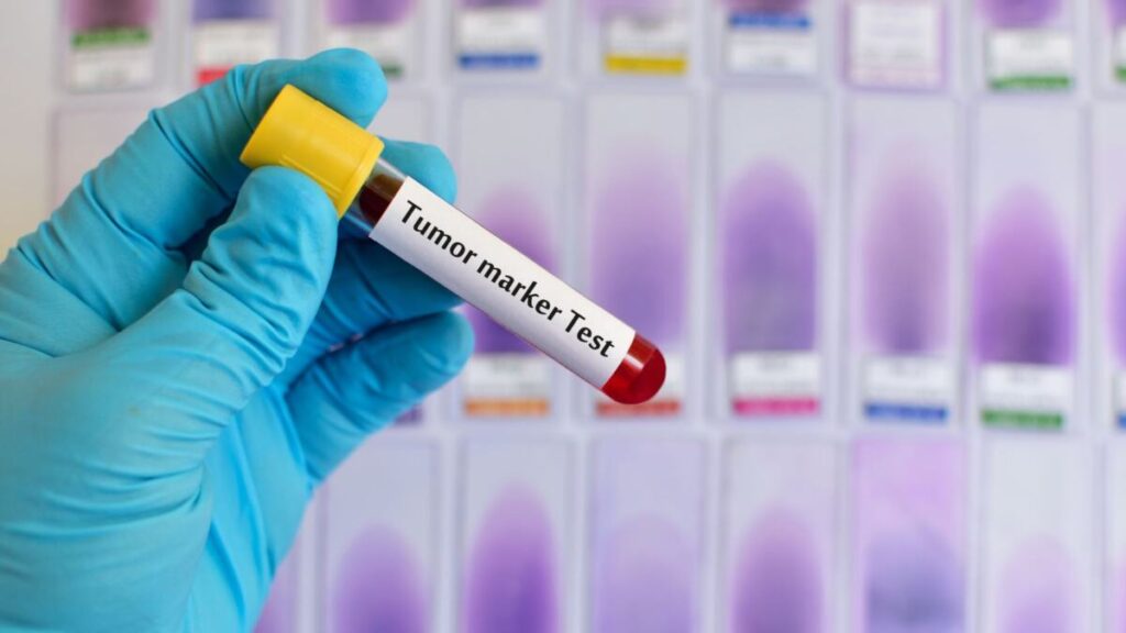 A lab technician examines a blood sample for brain tumor markers