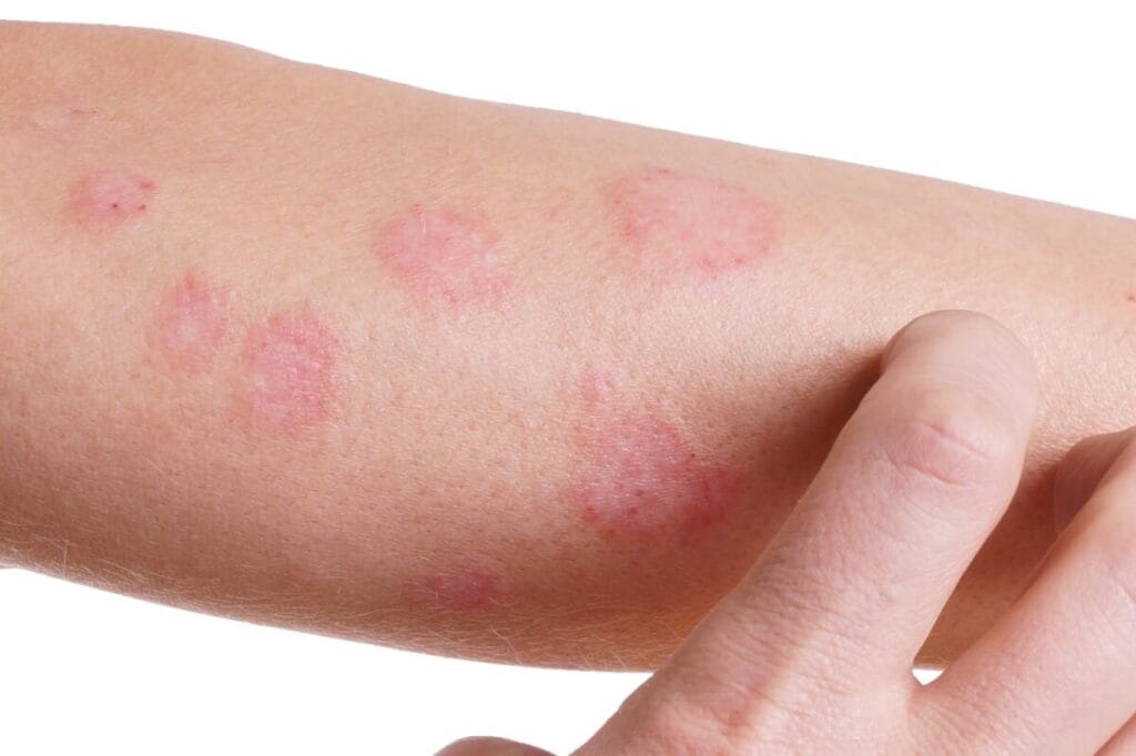 Skin with characteristic rash of urticaria