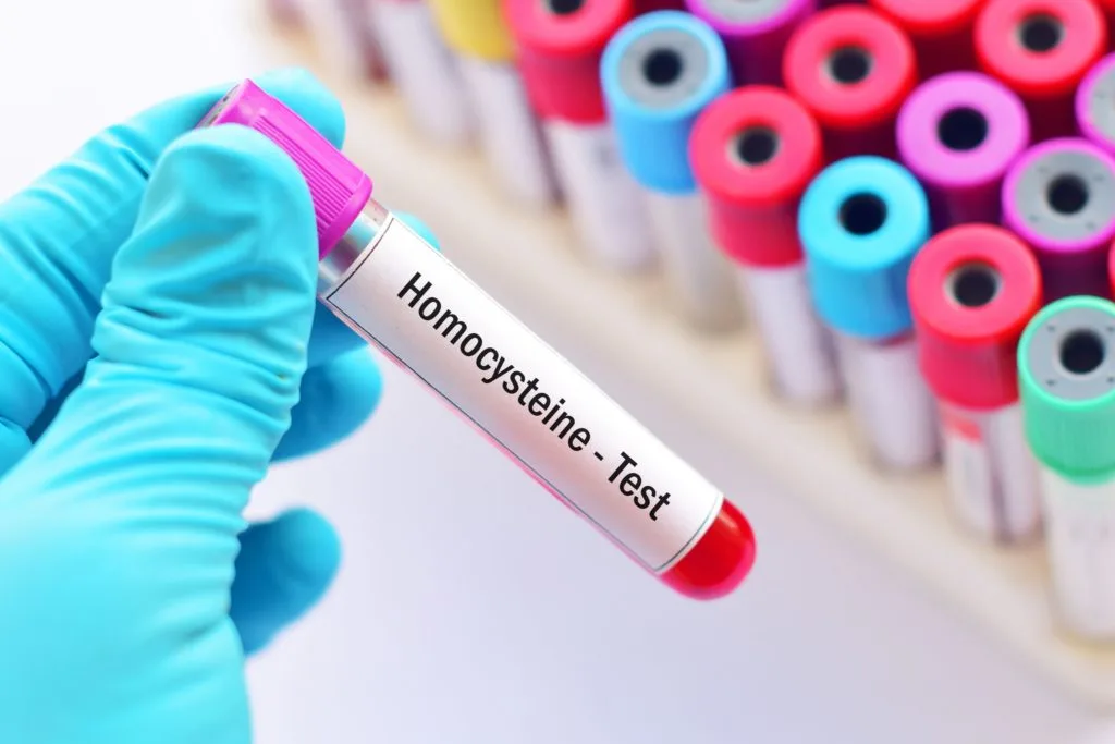 Table of normal and pathological homocysteine levels