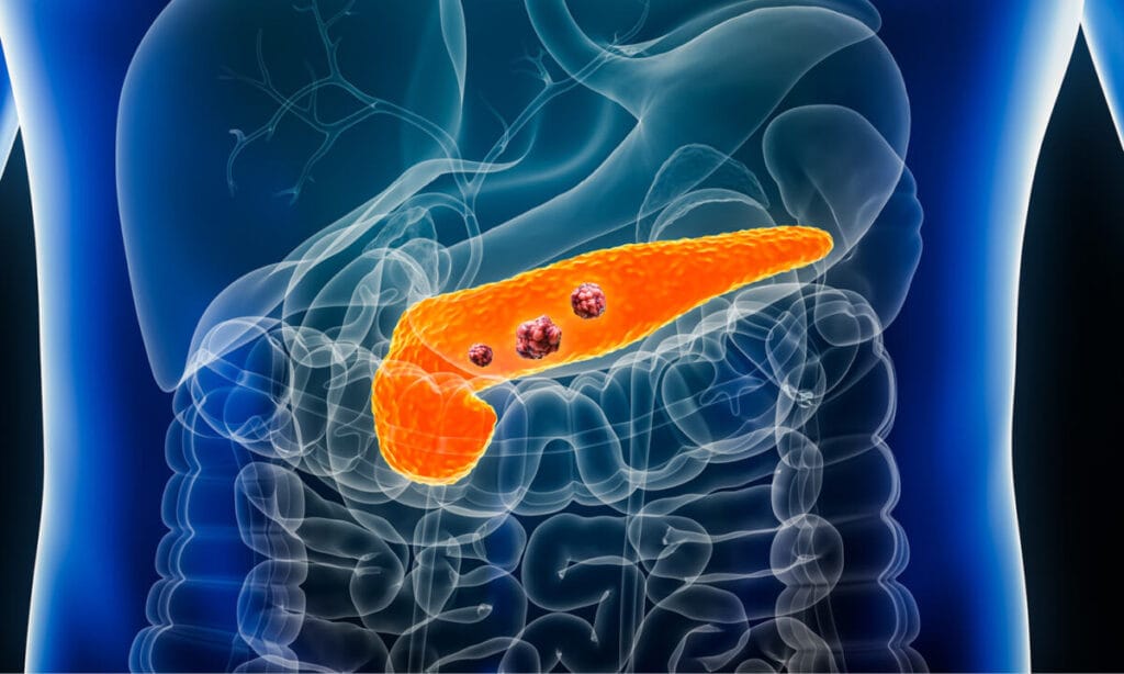 CA 19-9 test — a marker for pancreatic cancer