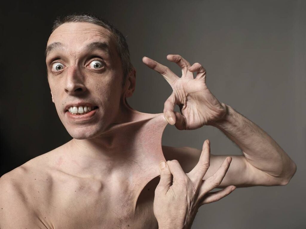 Ehlers-Danlos Syndrome – changes in collagen structure