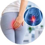 Anal fissures - histological examination