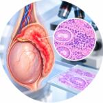 Examination of the removed testicle and its appendix in inflammatory diseases