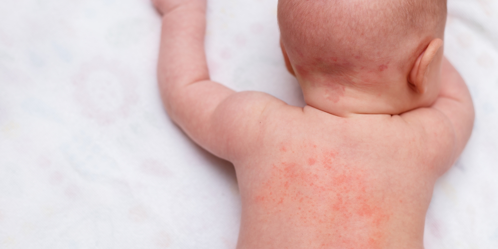 прояви харчової алергії у немовлят