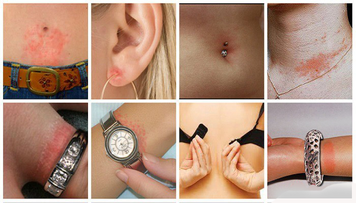 нікелева алергія висип на шкірі після контакту з металом