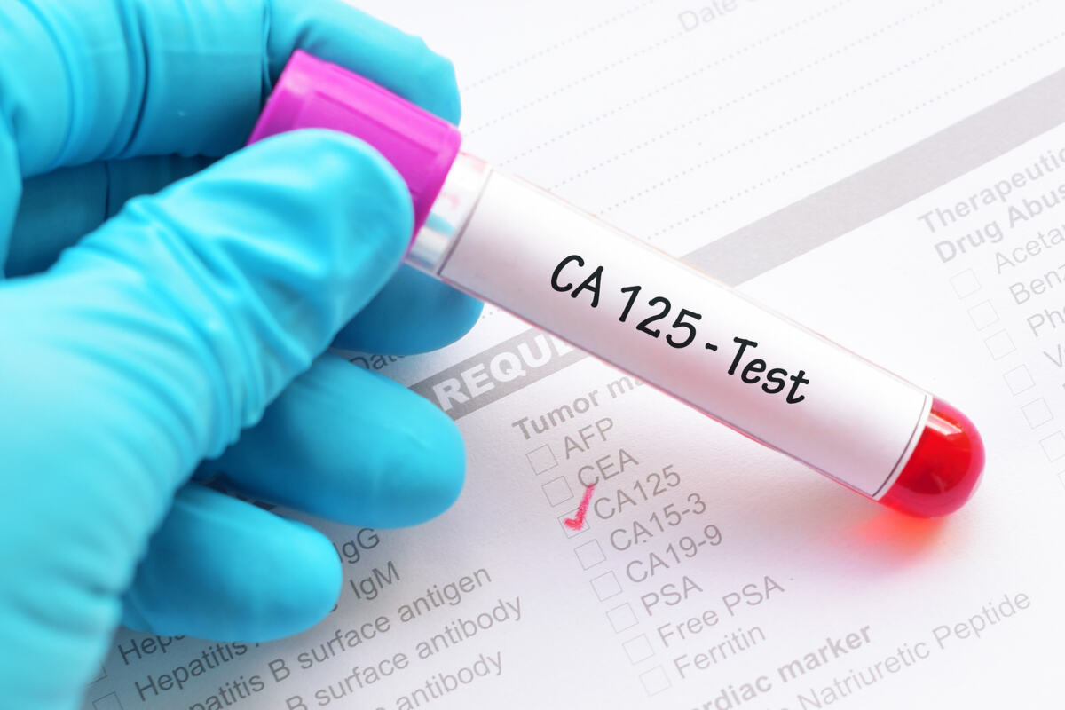 CA-125 HPV test and PAP test for suspected uterine cancer