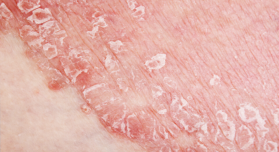 уход за кожей при атопическом дерматите эмолиенты и лечение