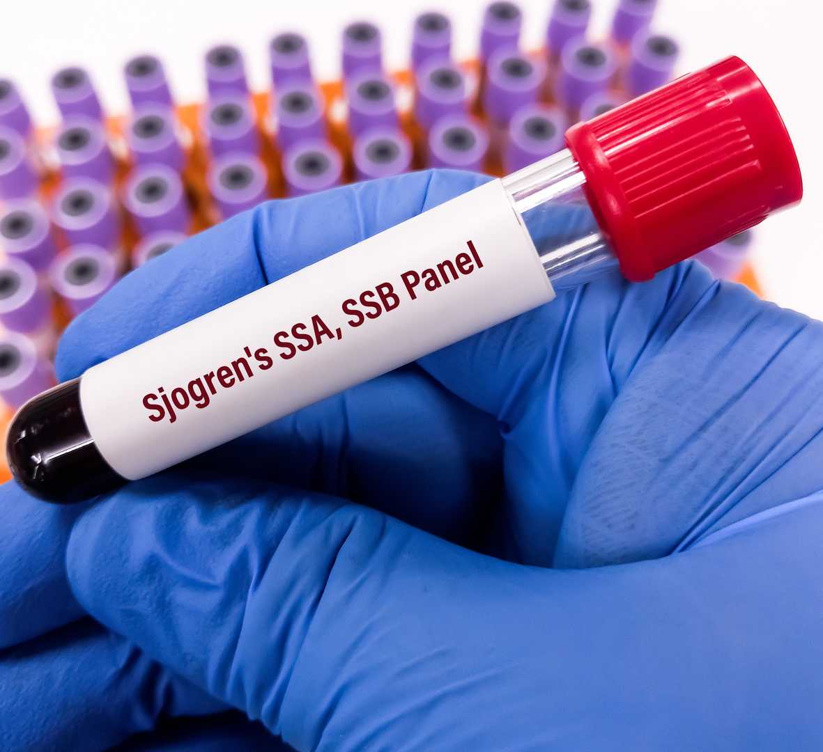 Anti SSA Ro Anti SSB La ANA и ревматоидный фактор при подозрении на синдром Шегрена